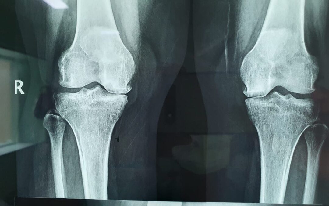42 Years Old Female Was Suffering From Osteonecrosis Dr. Neelabh