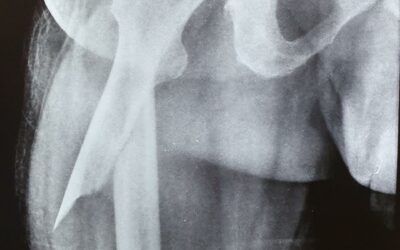 63 Years Old Male Suffered Fracture Of Right Upper Femur Bone (Thigh Bone)